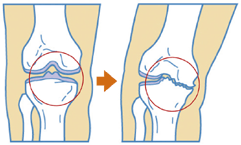 変形性膝関節症（骨関節炎）