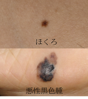 あなたのホクロ大丈夫ですか 皮膚科 診療の最前線 高松赤十字病院 日本赤十字社 香川県 あなたのホクロ大丈夫ですか 皮膚科 診療の最前線 高松赤十字病院 日本赤十字社 香川県