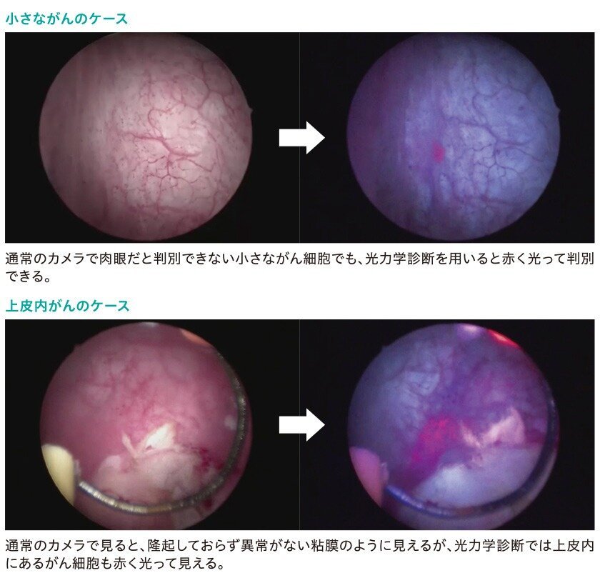 小さながんのケース、上皮内がんのケース