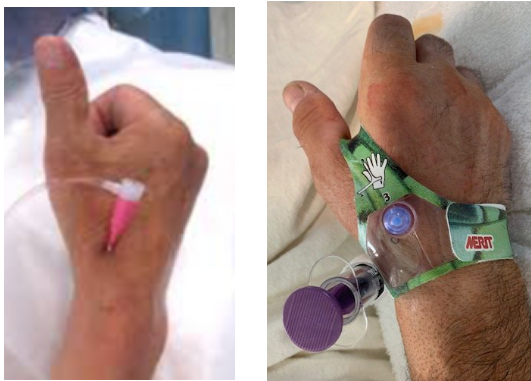 遠位橈骨動脈より穿刺