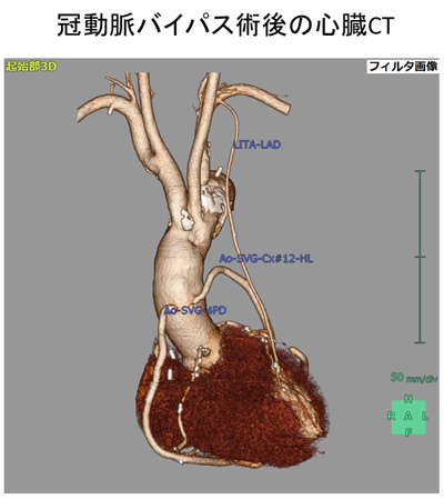 図1　冠動脈バイパス術後の心臓CT