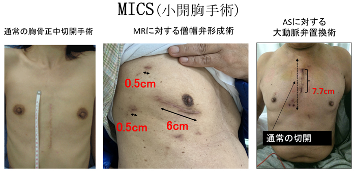 図3 MICS（小開胸手術）
