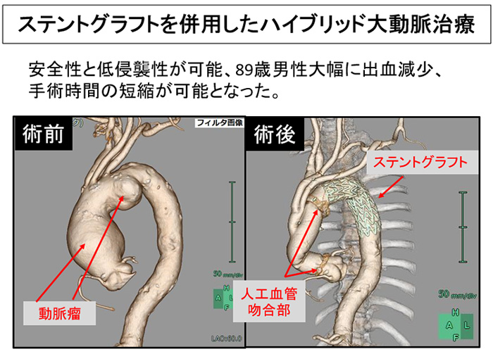 図4 ステントグラフトを併用したハイブリット大動脈治療