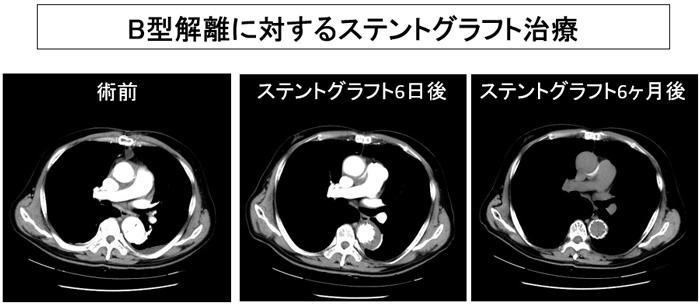 図5 B型解離に対するステントグラフト治療