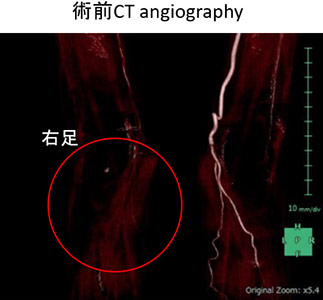 術前CT angiography