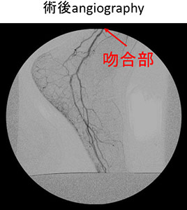 術後 angiography