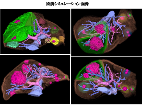 術前シミュレーション画像