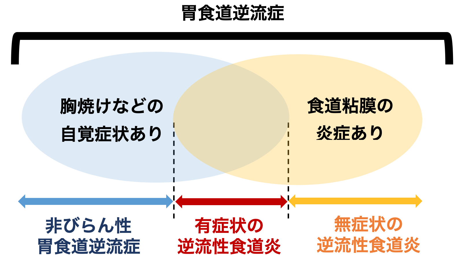 胃食道逆流症