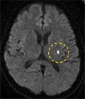 MRI（拡散強調画像）における急性期ラクナ梗塞（白い点）