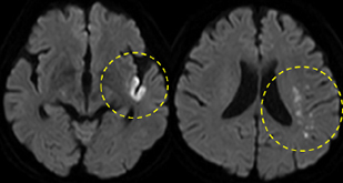 MRI（拡散強調画像）：急性期アテローム血栓性脳梗塞
