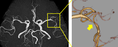 MRAおよび黄枠内を拡大した3D-MRA：中大脳動脈の狭窄（黄矢印）を認めます