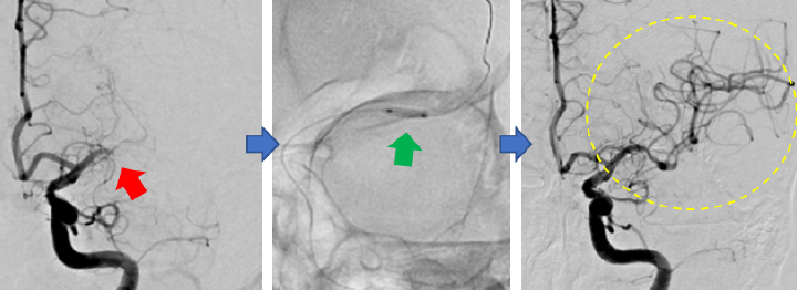 急性期脳血管内治療（血管形成術）
