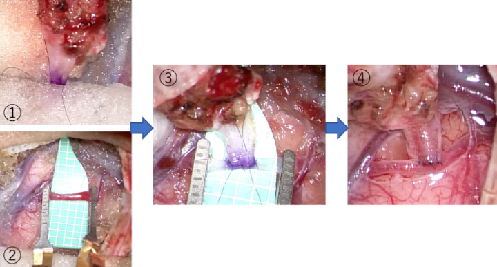 バイパス手術（浅側頭動脈-中大脳動脈吻合術）