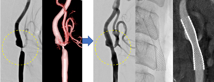 頚部頚動脈狭窄症に対するステント留置術（CAS）