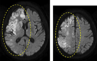 MRI（拡散強調画像）：急性期心原性脳塞栓症
