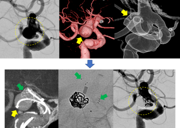 脳血管内治療（ステント併用塞栓術）