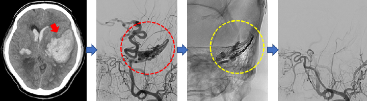 中頭蓋窩の硬膜動静脈瘻に対する血管内治療