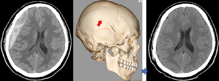 急性硬膜外血腫に対する開頭血腫除去術