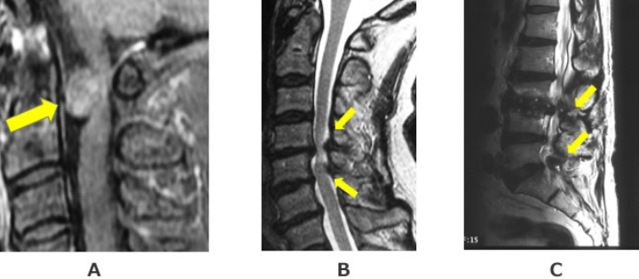 脊椎疾患のMRI