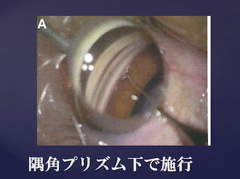 隅角プリズム下で施行