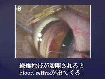 線維柱帯が切開されるとblood refluxが出てくる。