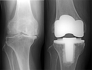 右膝手術前／人工膝関節手術後