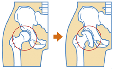 変形性股関節症