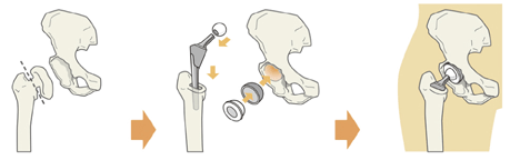人工股関節全置換術