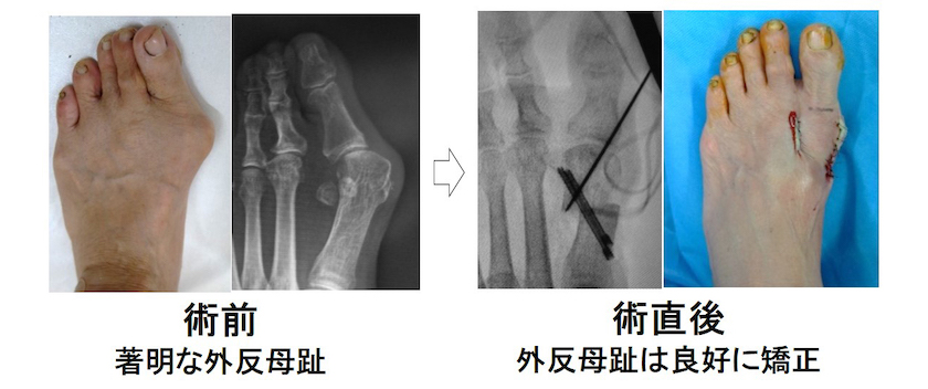 術前：著明な外反母趾→術直後：外反母趾は良好に矯正