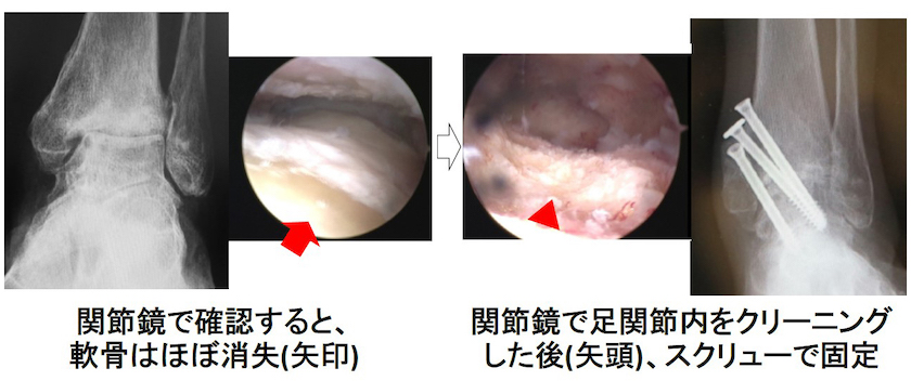 関節鏡で確認すると、軟骨はほぼ消失（矢印）→関節鏡で足関節内をクリニングした直後（矢頭）、スクリューで固定