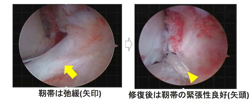 靭帯は弛緩（矢印）→修復後は人体の緊張性良好（矢頭）