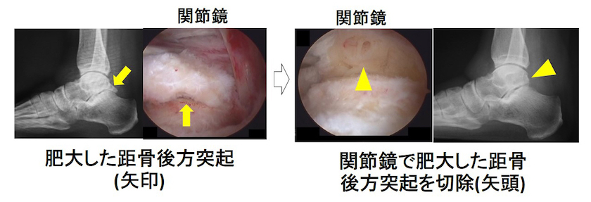 肥大した距骨後方突起（矢印）→関節鏡で肥大した距骨 後方突起を切除（矢頭）