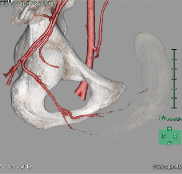 外傷により狭窄を生じた内陰部動脈