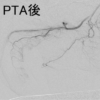 PTA後