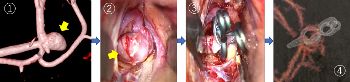 脳動脈瘤クリッピング術