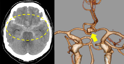 CT検査でくも膜下出血を認めました