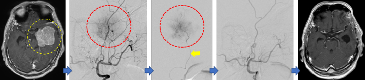 脳腫瘍に対する脳血管内治療