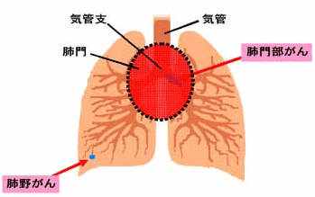 肺がんの診断